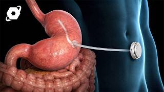 Stomach Drain Device